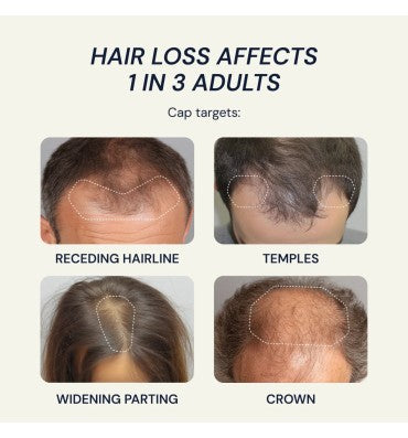 Laser Cap REVERSE HAIR LOSS • REGROW HAIR • CLINICALLY-BACKED
