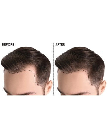 Recuperación Capilar RU58841 al 8% a base de Plantas.