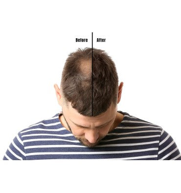 Recuperación Capilar RU58841 al 5% a base de Plantas.